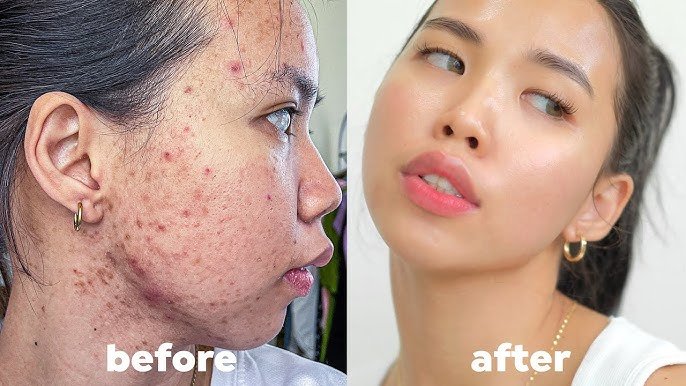 Before and After result D